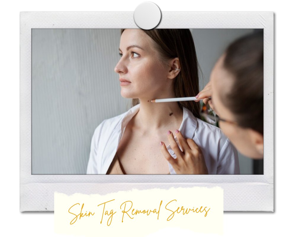 skin tag removal services tristar facial